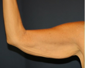 Feel Beautiful - Arm Reduction 207 - Before Photo